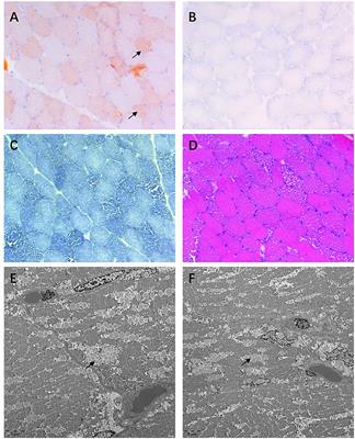 Lipid storage myopathy due to late-onset multiple Acyl-CoA dehydrogenase deficiency with novel mutations in ETFDH: A case report